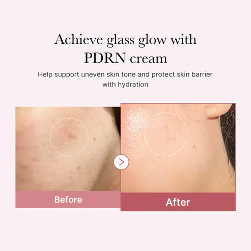 Medicube PDRN Pink Hyaluronic Moisturizing Cream — Achieve glass glow with PDRN cream Before After uneven skin tone improvement